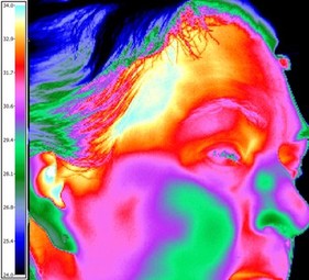 Carotid Thermology Example