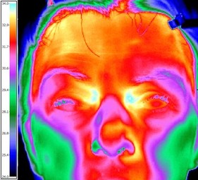Carotid Thermology Example