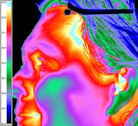Carotid Thermology Example
