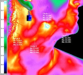 Thyroid Thermology Example