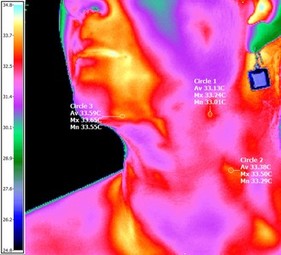 Thyroid Thermology Example