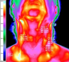 Thyroid Thermology Example
